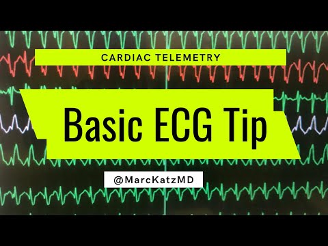 Basic ECG Tip: guess this cardiac telemetry diagnosis