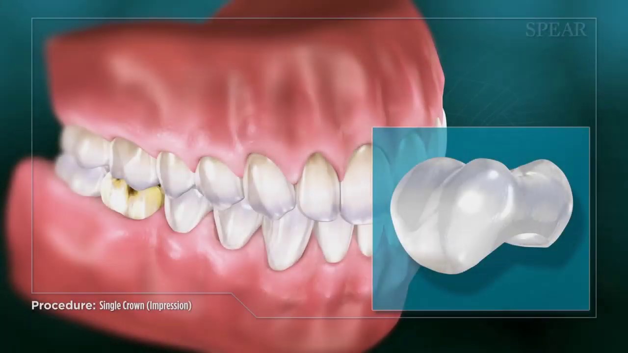 Dental Crown Overview | Triangle Dental 🦷