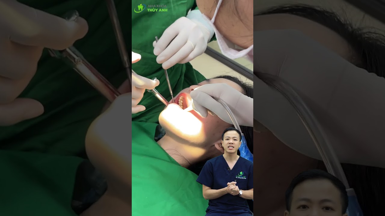 Nhược điểm của nhổ 1 lần 4 răng khôn? #nhakhoathuyanh #dentist #nhorang