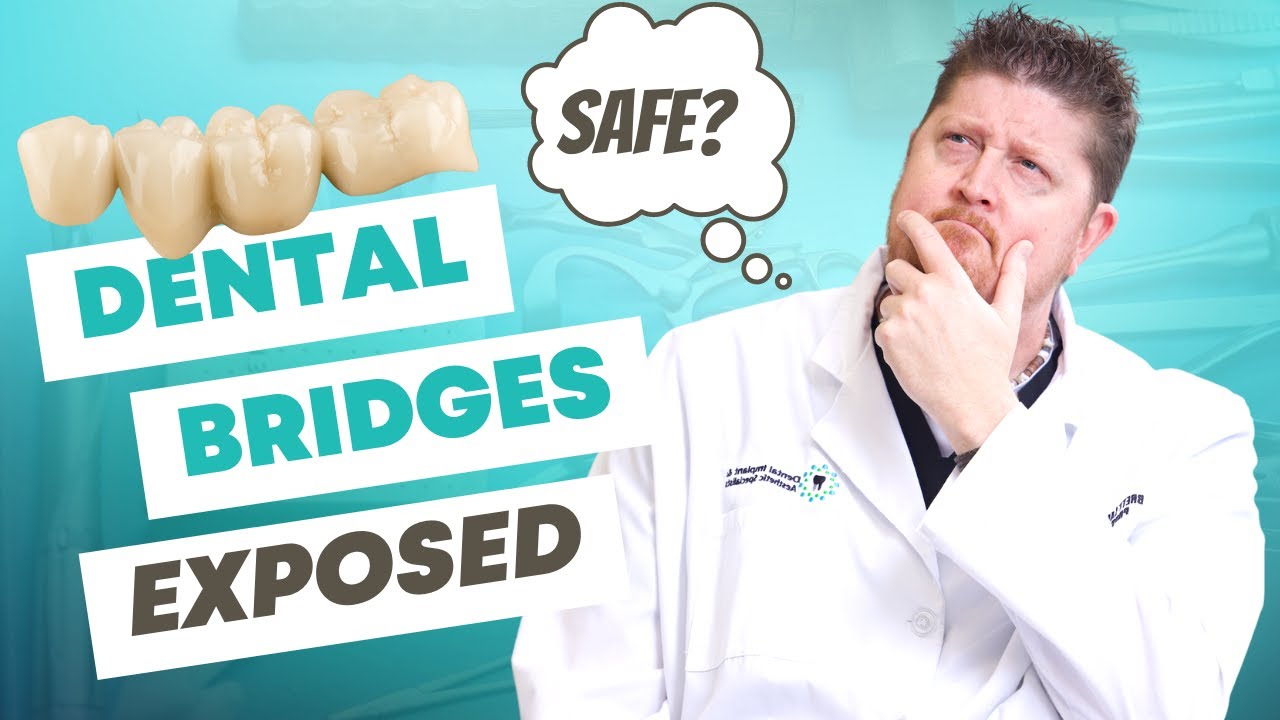 5 Must-Know Facts About Dental Bridges 🦷