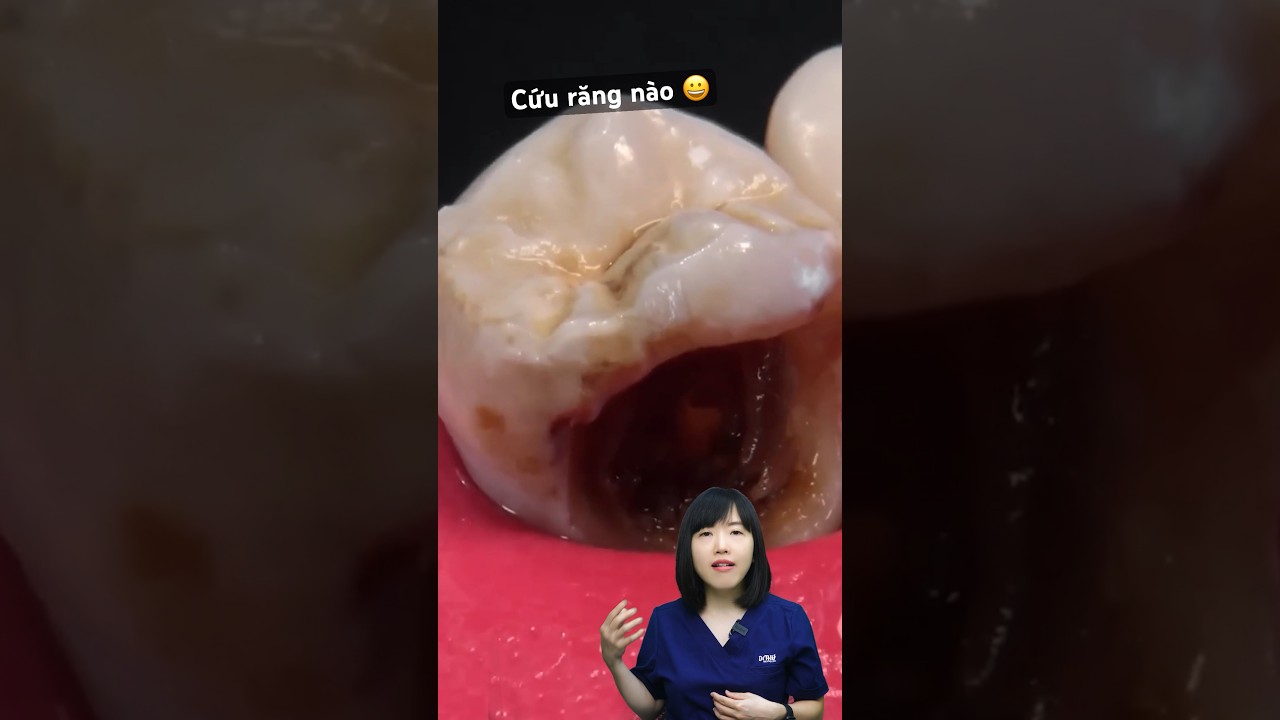 Cứu Răng Sâu Vỡ Lớn | Dr Anh Thư 🦷