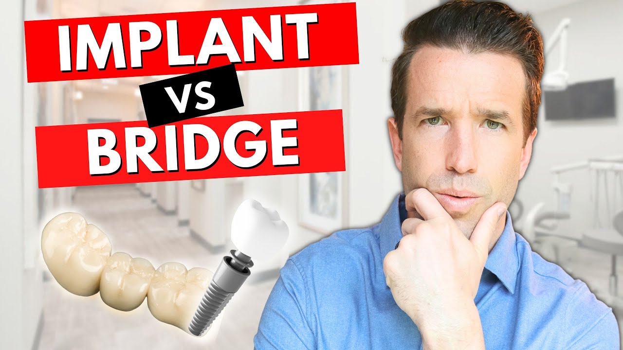 Dental Implants vs Bridges: Which is Better? 🦷