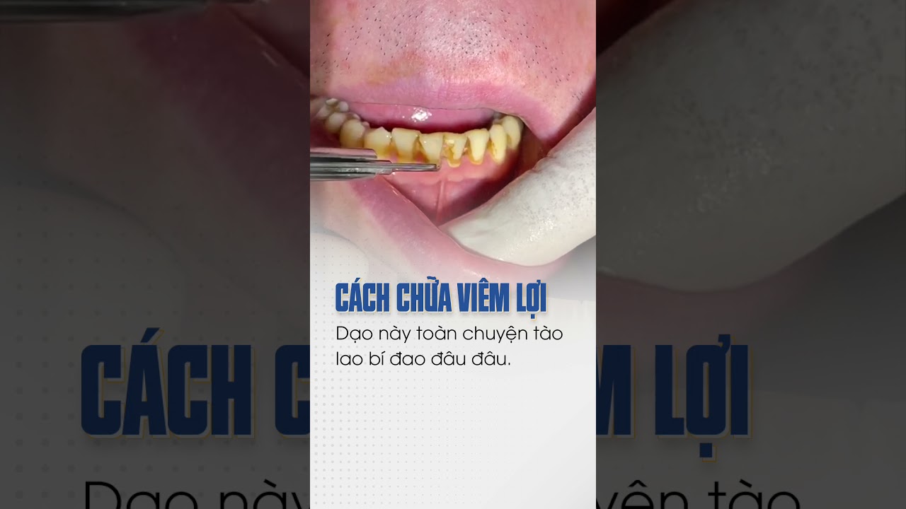 Chữa Viêm Lợi Hiệu Quả | Nha Khoa Ngân Phượng 🦷