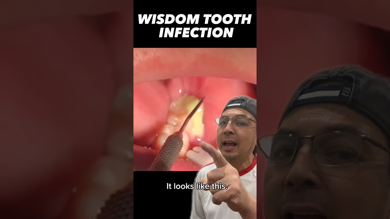 Quick & Effective Wisdom Tooth Infection Treatment 🦷 | Dental Tips & Tricks