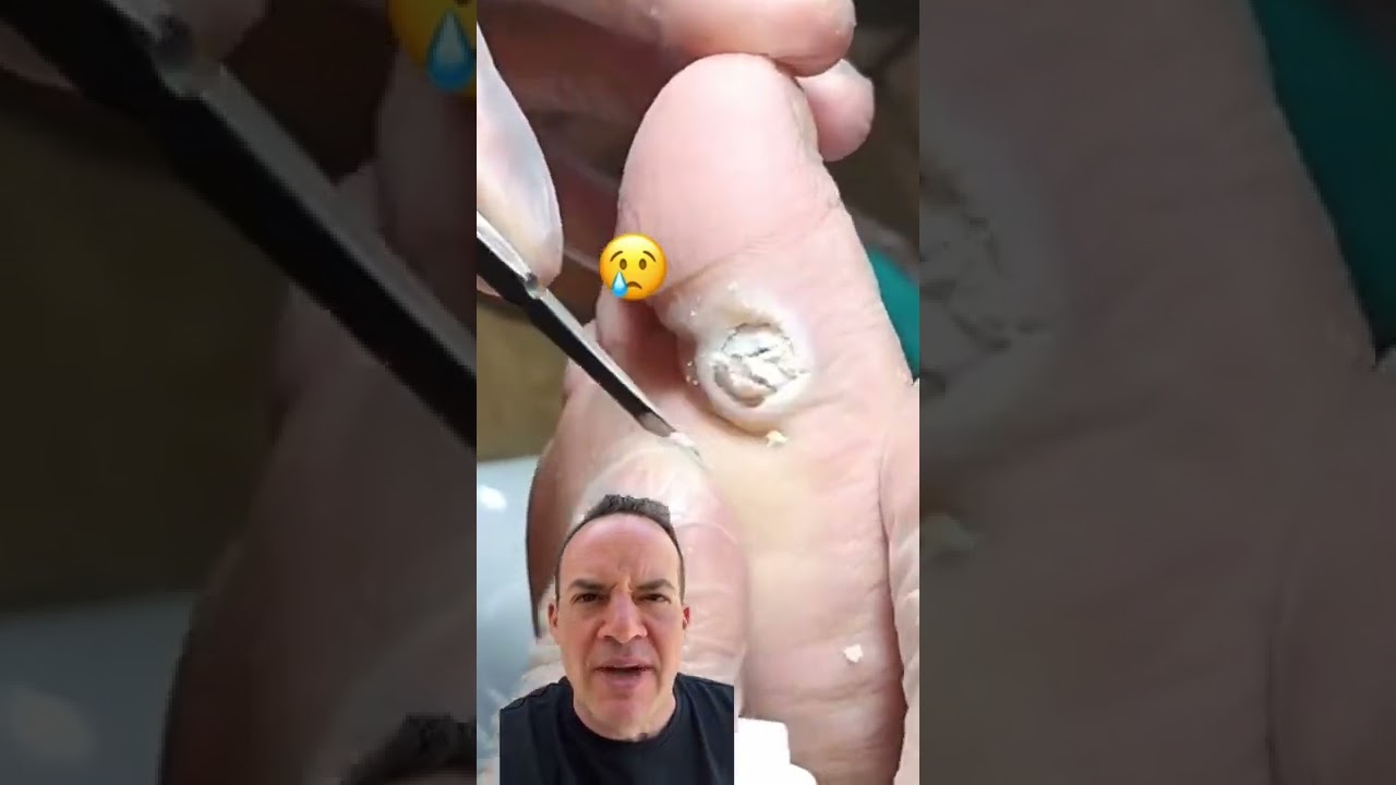 Doctor Reacts: Effective Plantar Wart Cure! 😱