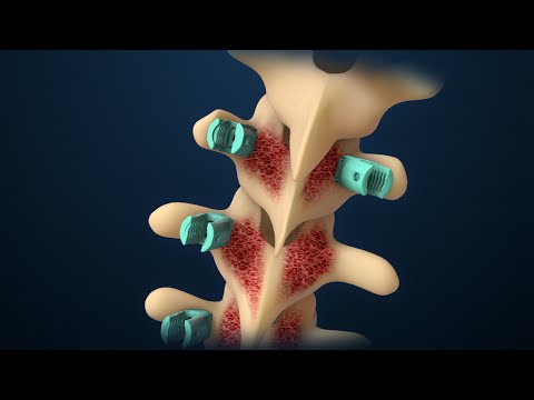Scoliosis | Scoliosis Surgery | Nucleus Health