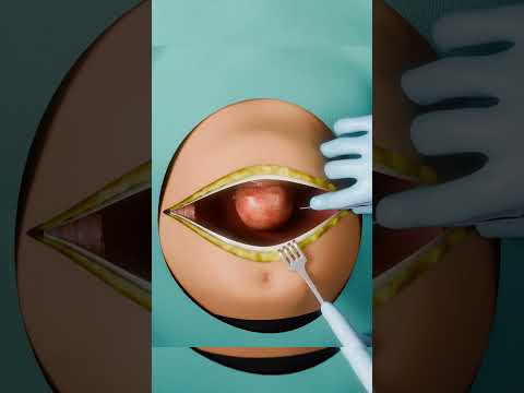 اغرب شئ في الولادة القيصرية 😱🚨 #دكتور #طبيب #ترند #اسعافات_اولية #مصر