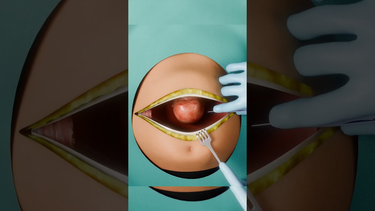 أغرب ما يحدث أثناء الولادة القيصرية 😱 | حقائق لا تصدق عن العمليات الجراحية