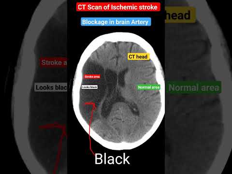 CT scan of ischemic stroke l दिमाग में नस बंद का सीटी स्कैन #stroke #shorts
