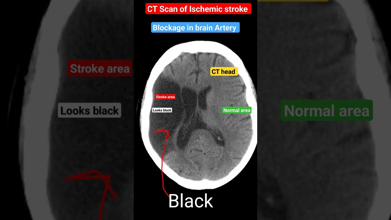 Understanding Ischemic Stroke: Brain CT Scan Explained 🧠