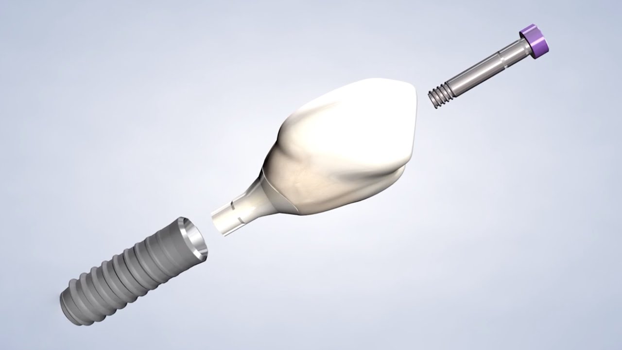 Dental Implants at Cincinnati's Oral Surgery Experts 🦷