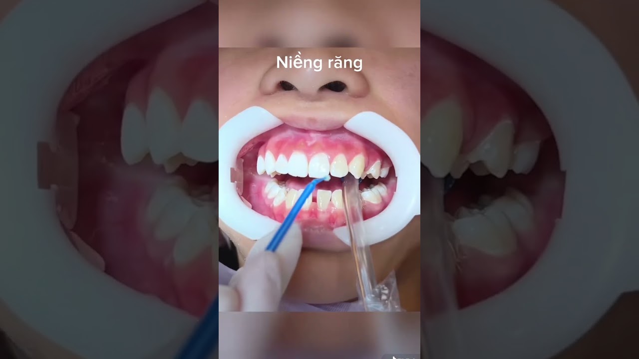 Gắn Mắc Cài Niềng Răng 🤣