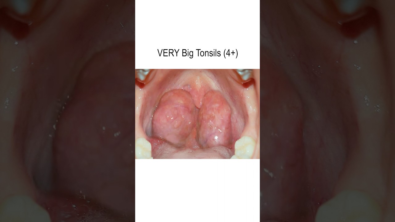 Tonsil Growth from None to 4+ 📈