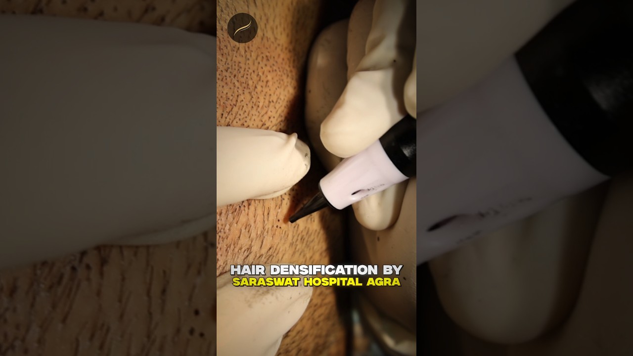 Top Hair Loss Solution: Scalp MicroPigmentation 💇‍♂️