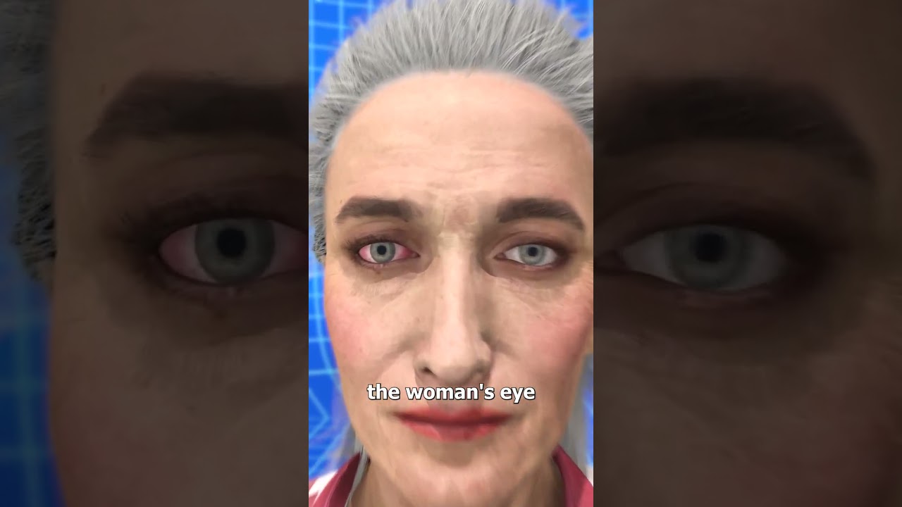 23 Contacts Stuck in Her Eye 😨