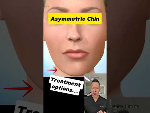Asymmetric Chin? Here’s How to Correct It! #dentallan #dentist #shorts