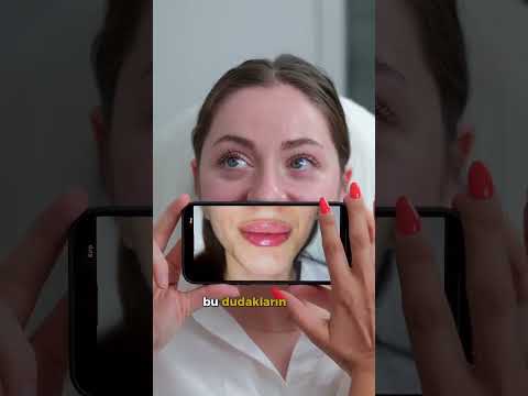 DUDAK DOLGUNU SEÇ #dudak #dolgu #dudakdolgusu