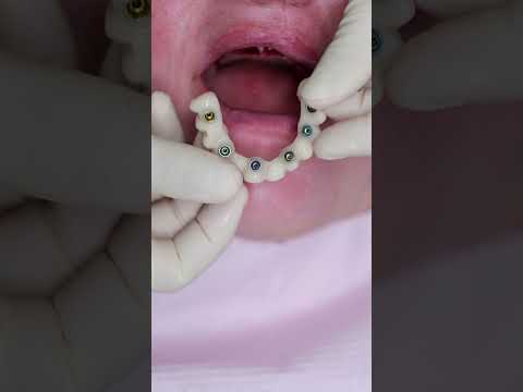 Dental implant’s All on 4 #shorts #smile #impossible #dentist #best #new #beautiful #shortvideo