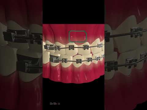 How Does Dental Braces Work