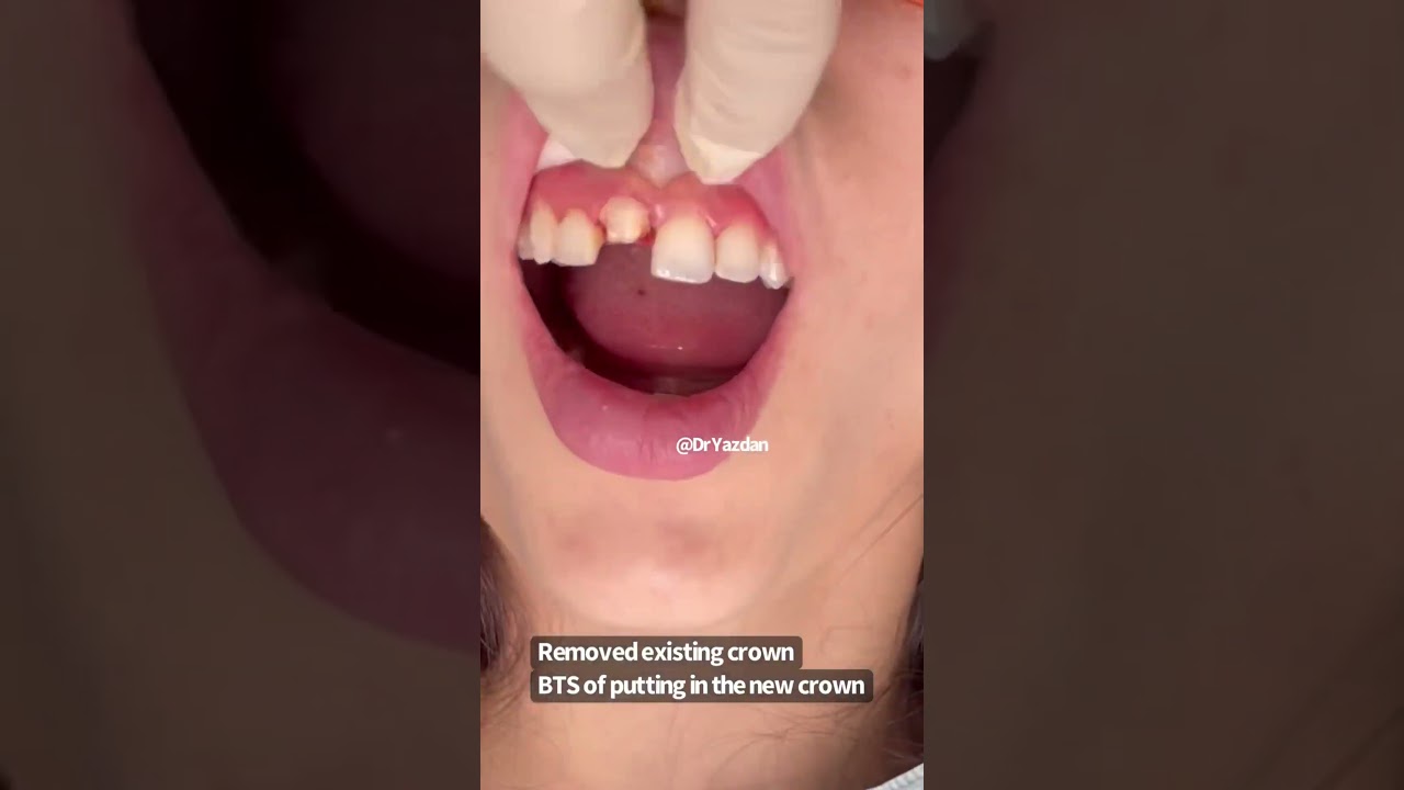 Front Tooth Crown Procedure by Dr. Yazdan 🦷