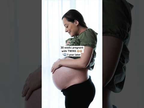 TWIN birth tummy recovery ❤️‍🩹 One year post C-section! #twins #twinmum #twinpregnancy #cesarean