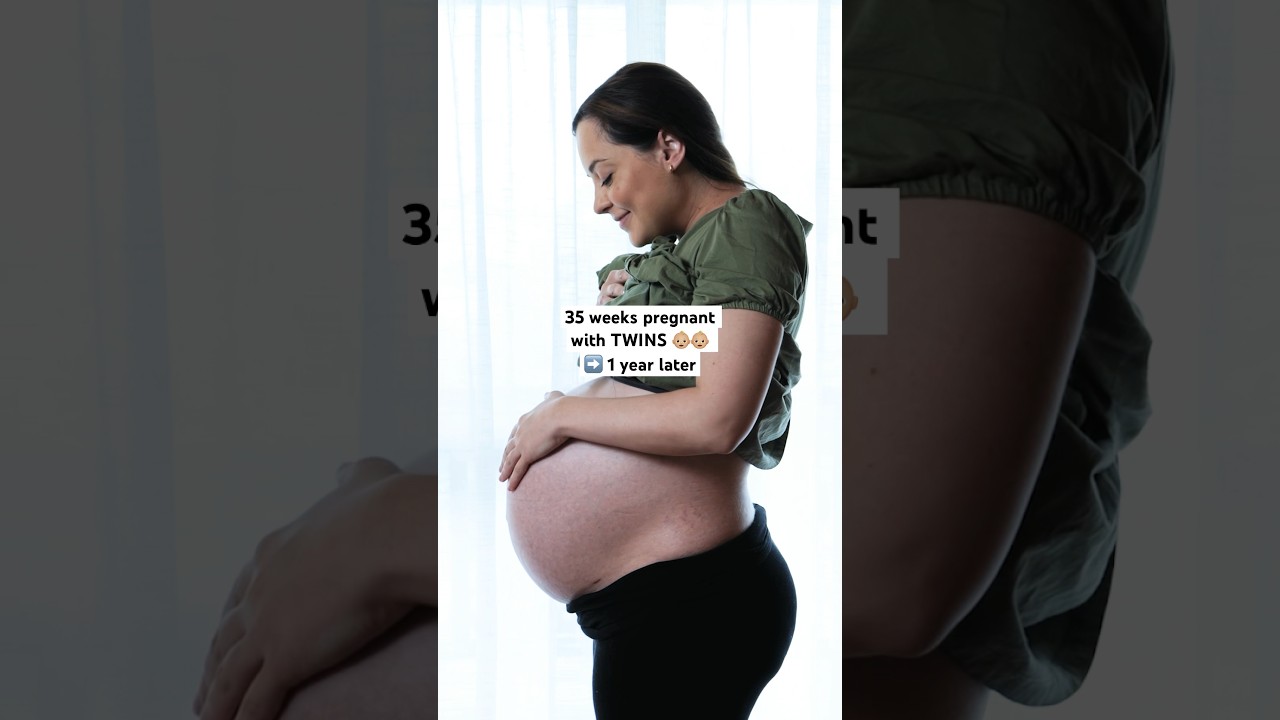 Twin Birth Tummy Recovery: One Year Post-C-Section Journey β€οΈβπ©Ή