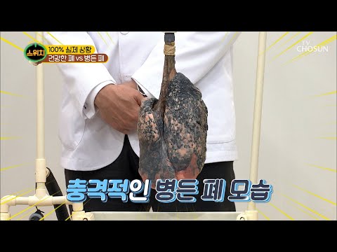 충.격.실.화 병든 폐 vs 건강한 폐 차이는?  [스위치] 45회 20200518