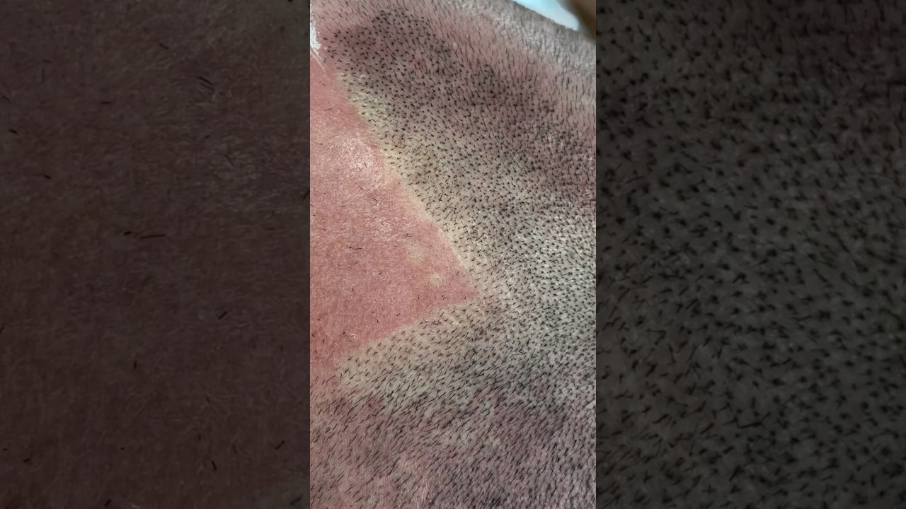 How Real Can SMP Look? | Scalpmicropigmentation 🎯