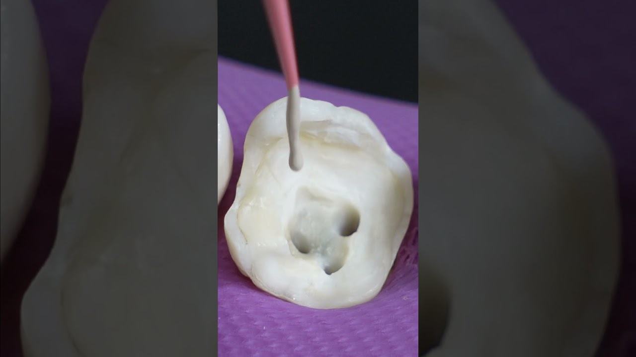 Satisfying Root Canal & Crown Process 😊