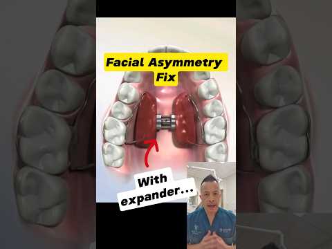 Fixing Facial Asymmetry with a Palate Expander: Here's How! #dentallan #dentist #shorts