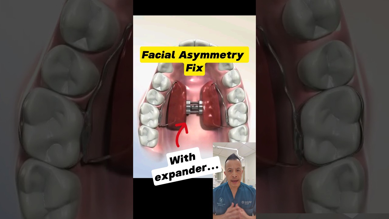 Correct Facial Asymmetry with a Palate Expander π¦· | Dental Tips