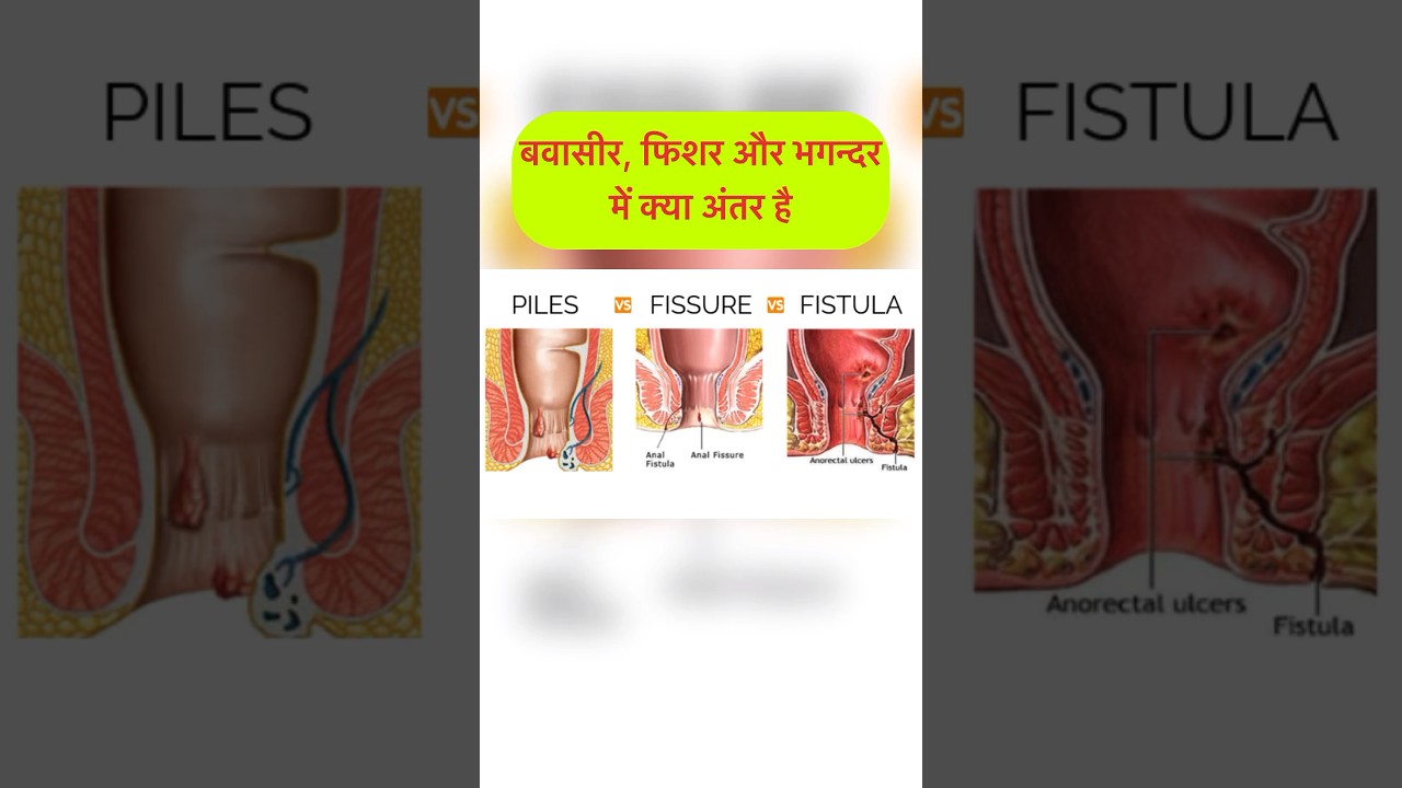बवासीर, फिशर और भगन्दर में क्या अन्तर है । Piles, Anal Fissure & Fistula #viral #shorts #shortsvideo