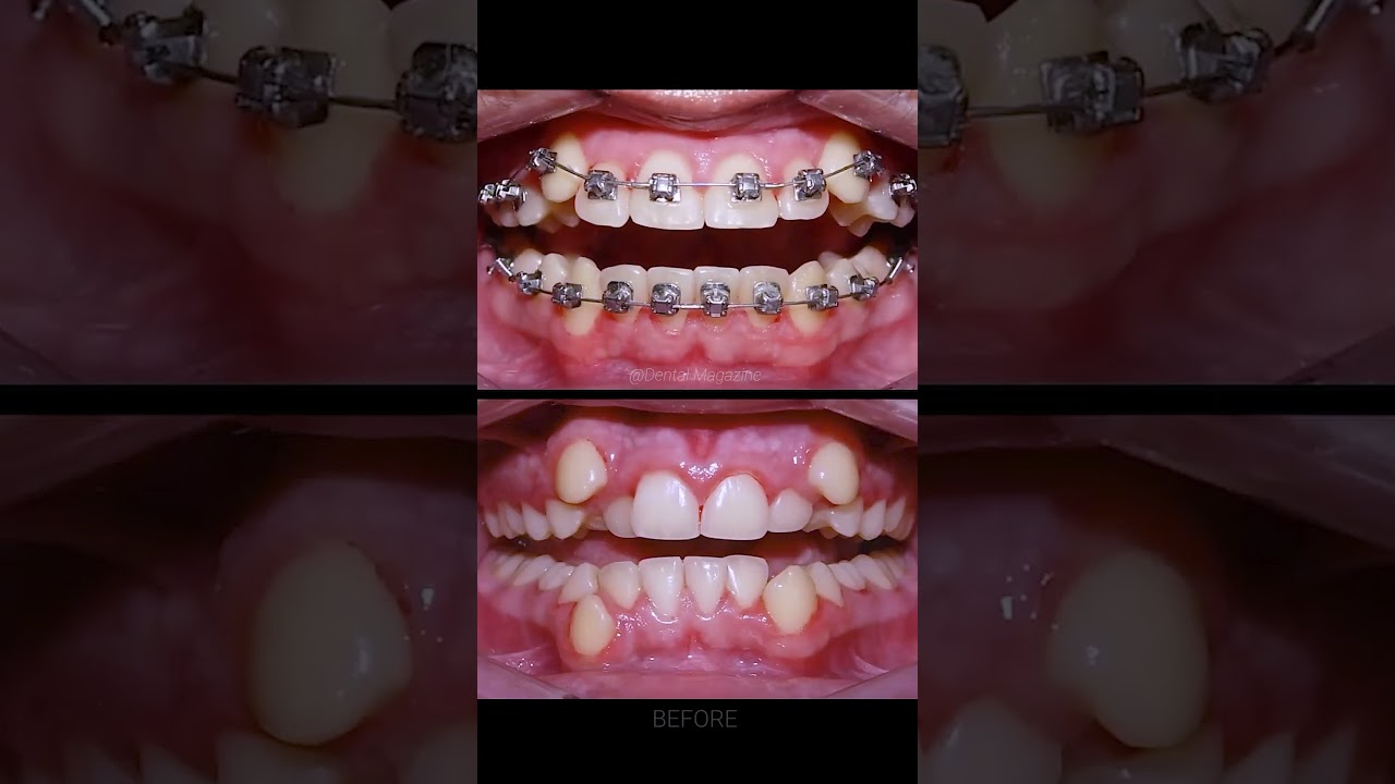 Braces Treatment Process 🦷