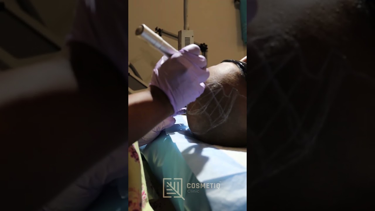 Scalp Micropigmentation by Dr. Bibilash 💈