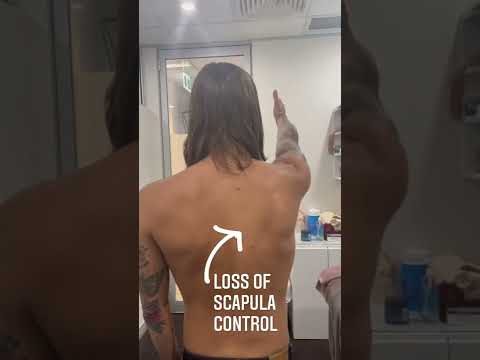 Here is some pretty extreme evidence of loss of scapula control and scapula winging!