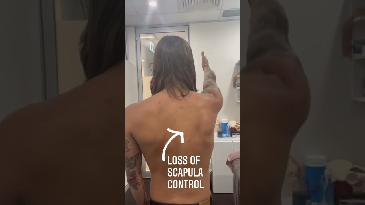 Shocking Evidence of Severe Scapula Winging and Control Loss 🩺