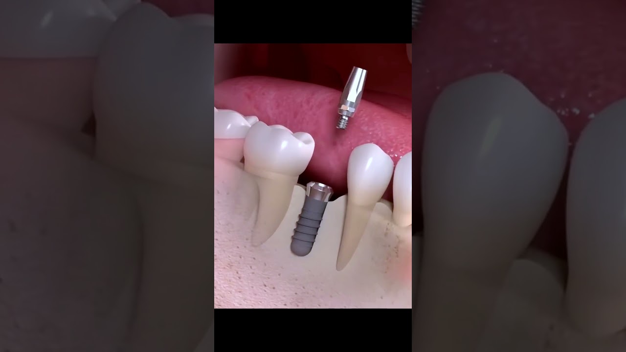Chi phí cấy ghép 1 răng implant 🦷
