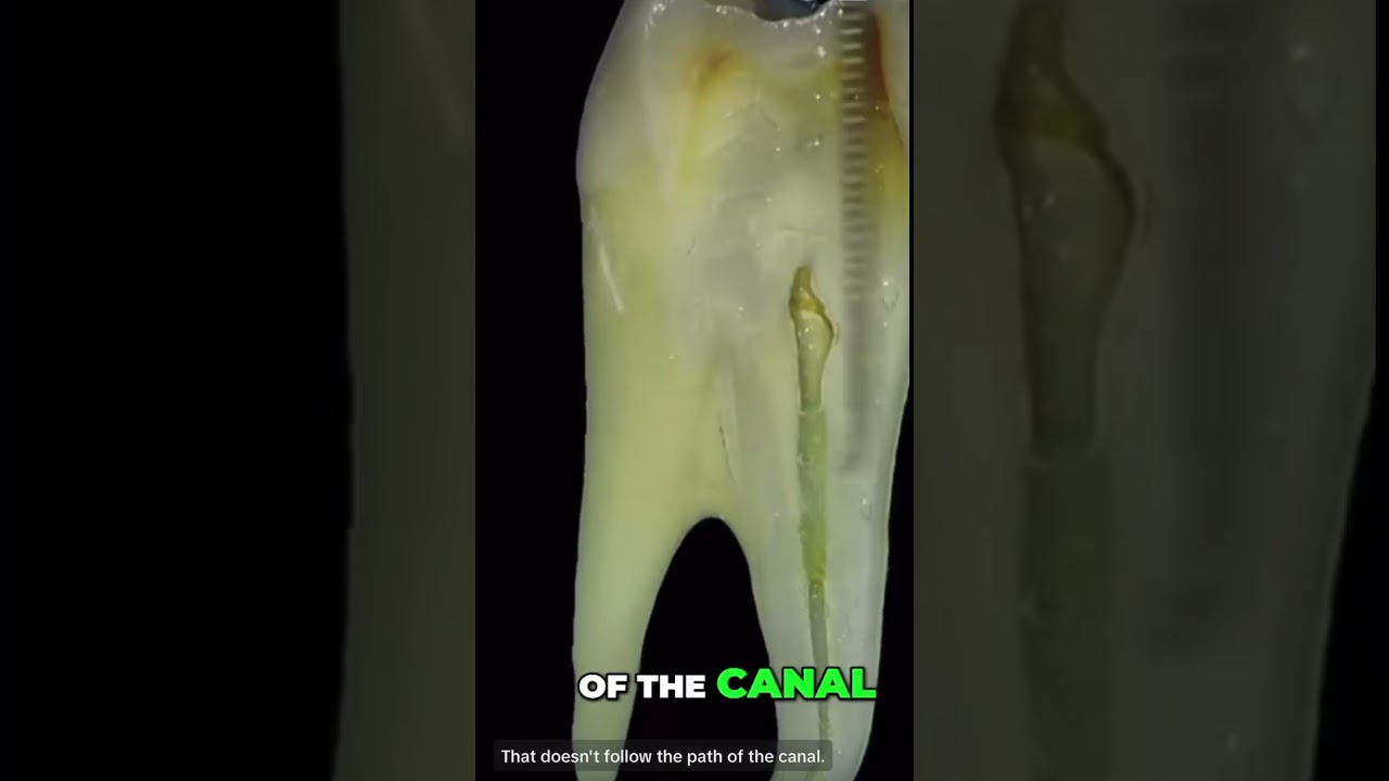 How to manage a ledge. #endodontics #ledge #rootcanal #dentistry #dentist