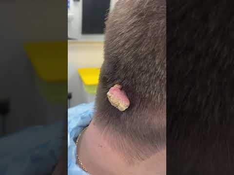 Dr. Medispa Removes Large Cauliflower Wart 😱