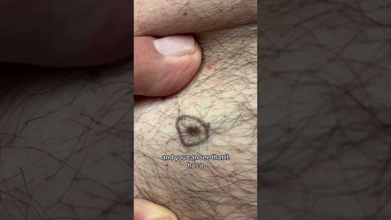 Dermatologist with 50 years experience shows mole to remove and check for cancer👨🏻⚕️
