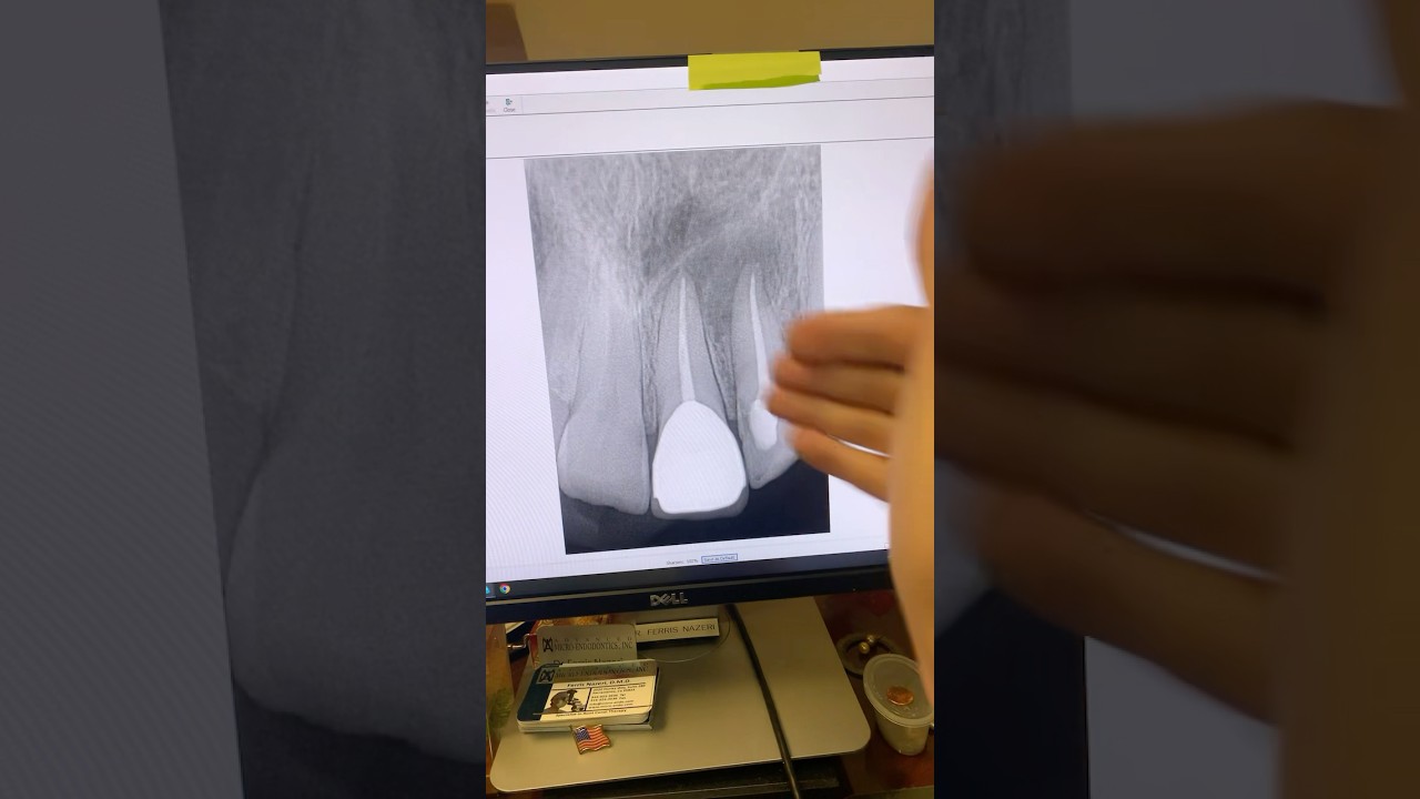 Why Do Root Canals Fail Despite Looks? 🤔