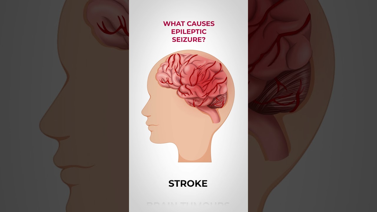 Understanding Epileptic Seizures: Common Causes and Triggers π§