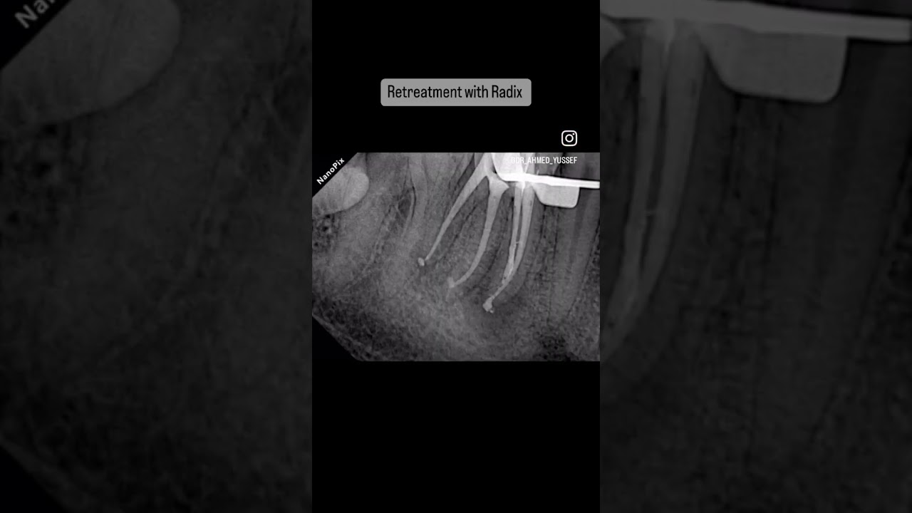 Lower Molar Endodontic Retreatment 🦷