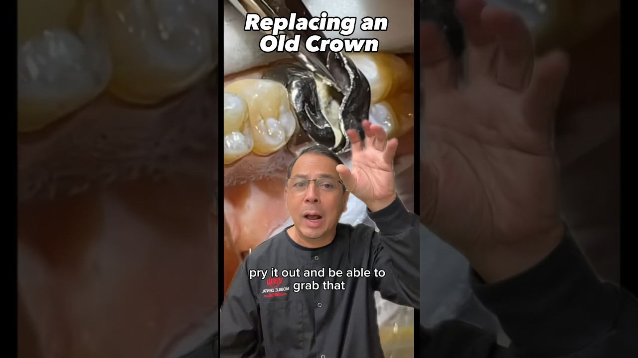 Dental Crown Replacement Procedure 🦷