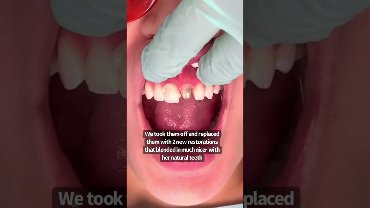 2 Smile Makeover with Porcelain Crowns by Dr. Yazdan 😁