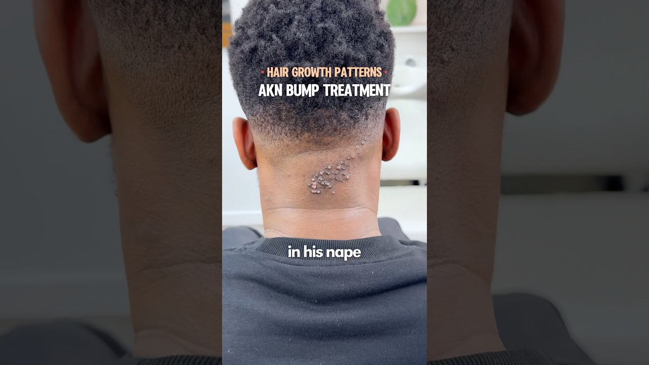 Effective AKN Hair Removal Treatment ✂️