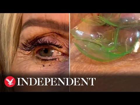 Doctor Extracts 23 Contact Lenses from Patient's Eye 👁️