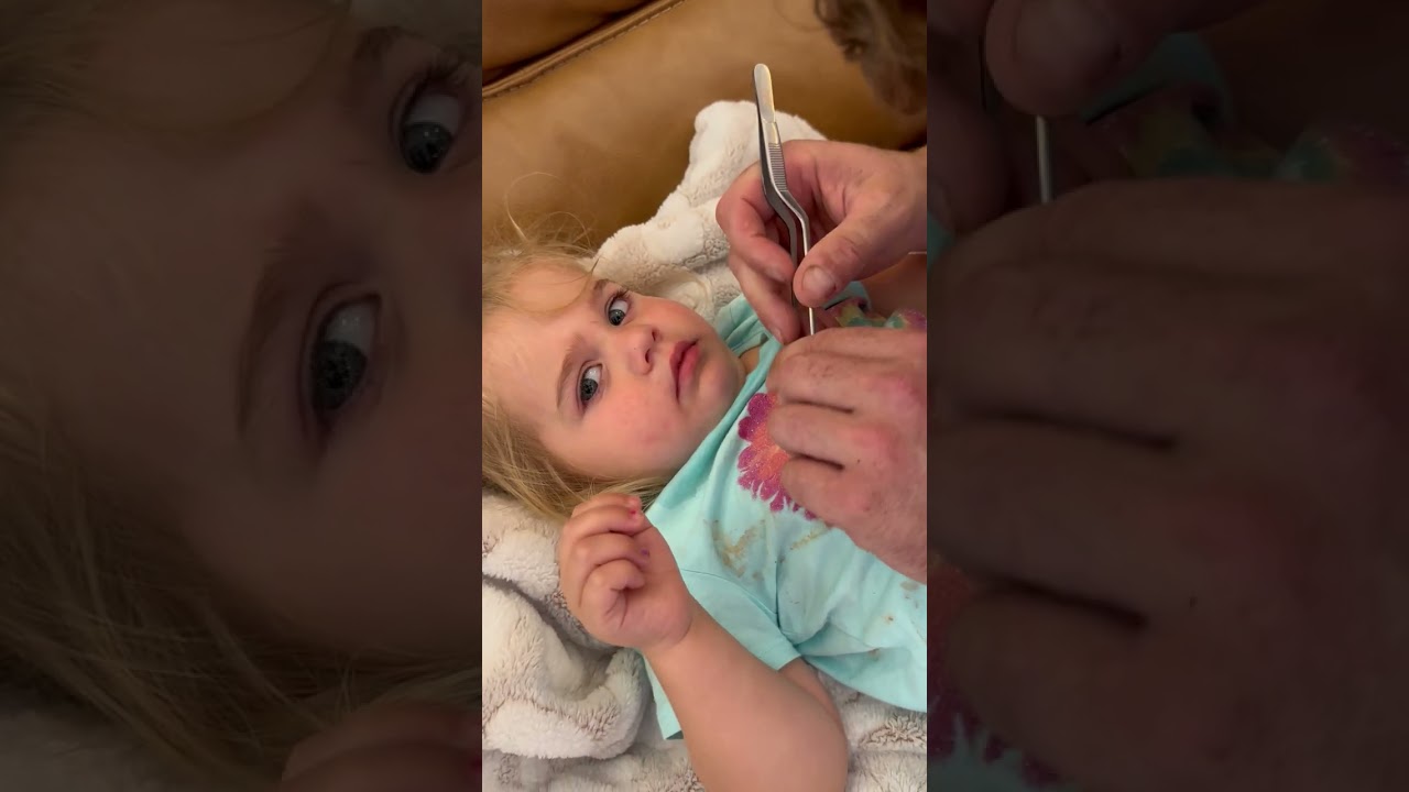 Dad Uses Tweezers to Remove Pony Bead from Daughter's Nose