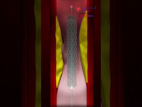 Heart Attack Treatment || HEART STENT || Angioplasty ||- PCI