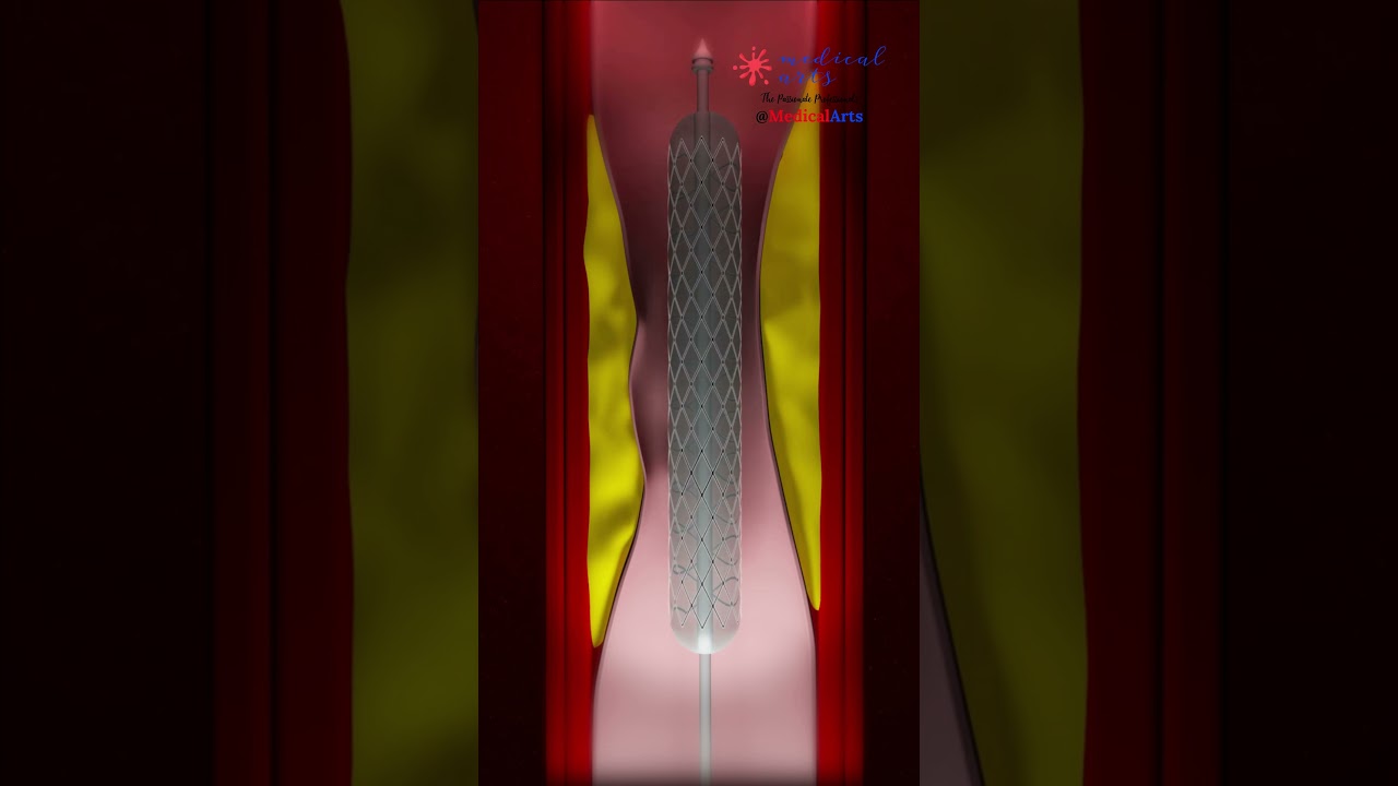 Life-Saving Heart Attack Treatment: Heart Stent & Angioplasty Explained ❤️